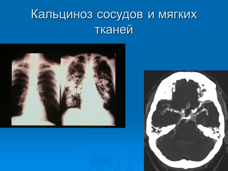 Кальциноз сосудов и мягких тканей